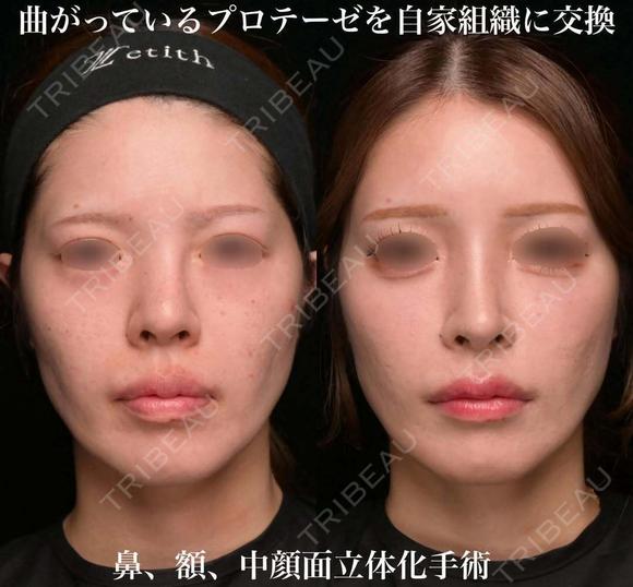 曲がっているプロテーゼを自家組織に交換 before画像 メイン用