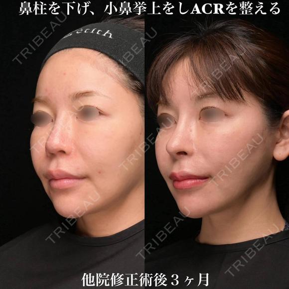ACRを整える 90日後 メイン用