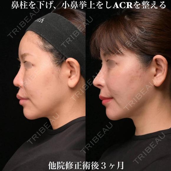 ACRを整える 90日後 メイン用