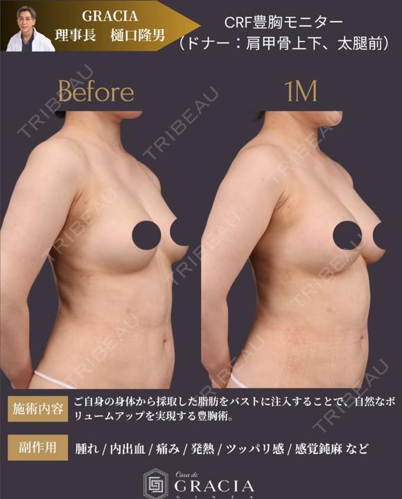 コンデンスリッチ豊胸 before画像 メイン用