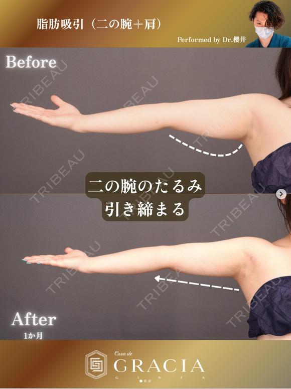 ベイザー二の腕＋肩脂肪吸引 30日後 メイン用