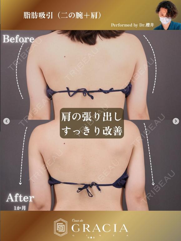 ベイザー二の腕＋肩脂肪吸引 before画像 メイン用