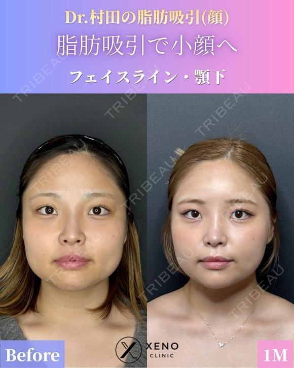 脂肪吸引（フェイスライン＋顎下） before画像 メイン用