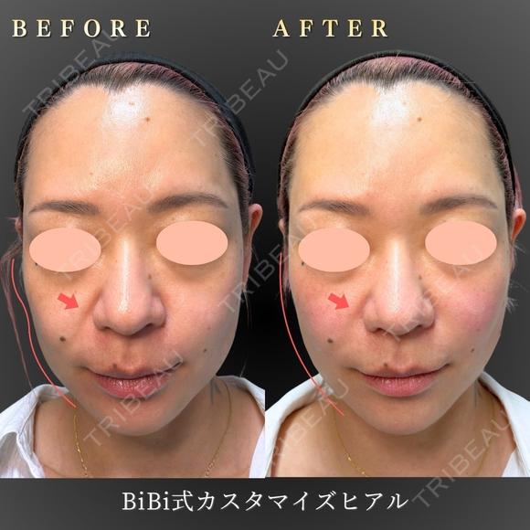 フェイスリフト/ヒアルロン酸注入 before画像 メイン用