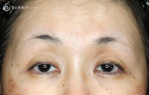 【50代女性・ハードコンタクトレンズ眼瞼下垂】切らない眼瞼下垂+α法（術直後〜1ヶ月後） before画像 メイン用