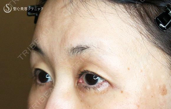 【50代女性・ハードコンタクトレンズ眼瞼下垂】切らない眼瞼下垂+α法（術直後〜1ヶ月後） 30日後 メイン用