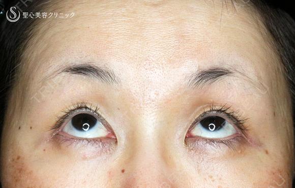 【50代女性・ハードコンタクトレンズ眼瞼下垂】切らない眼瞼下垂+α法（術直後〜1ヶ月後） 30日後 メイン用