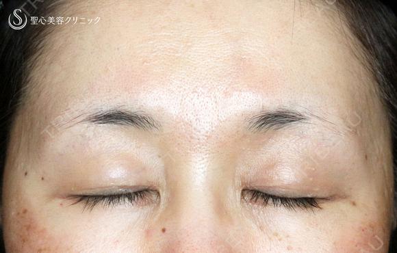 【50代女性・ハードコンタクトレンズ眼瞼下垂】切らない眼瞼下垂+α法（術直後〜1ヶ月後） 30日後 メイン用