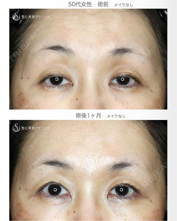 【50代女性・ハードコンタクトレンズ眼瞼下垂】切らない眼瞼下垂+α法（術直後〜1ヶ月後） 30日後 メイン用
