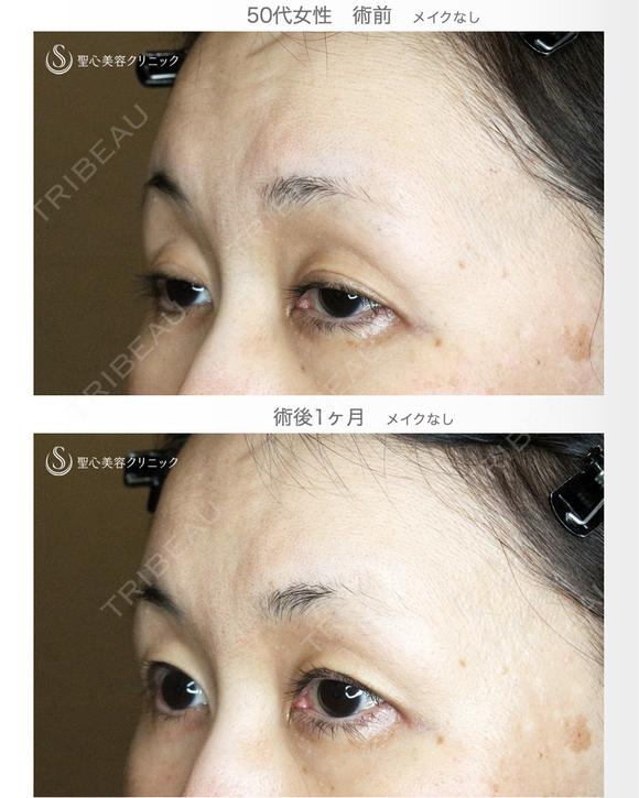 【50代女性・ハードコンタクトレンズ眼瞼下垂】切らない眼瞼下垂+α法（術直後〜1ヶ月後） 30日後 メイン用
