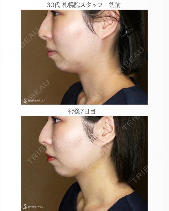 【30代女性・綺麗なフェイスライン】 7日後 メイン用