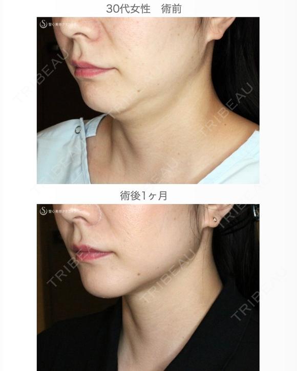 【30代女性・これだけで劇的変化】脂肪吸引注射 あご下（術直後〜1ヶ月後） before画像 メイン用