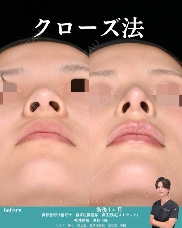 クローズ法鼻整形 30日後 メイン用