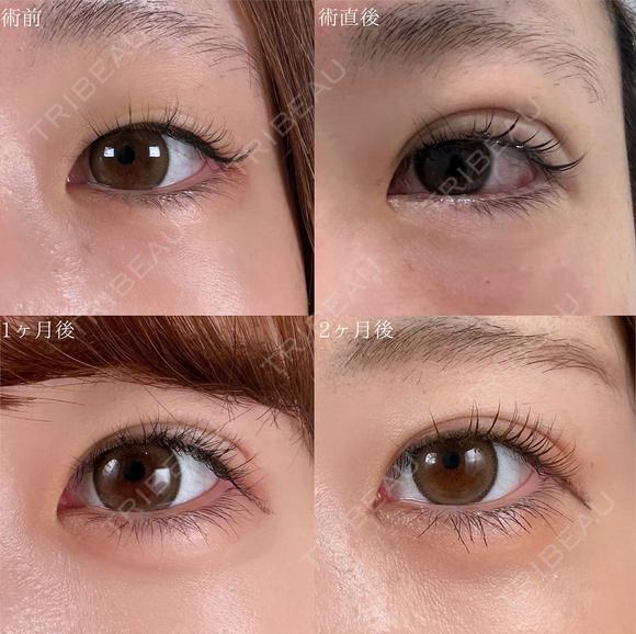 二重埋没法 before画像 メイン用