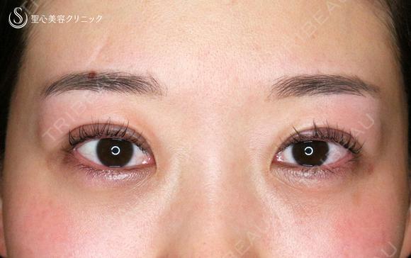 【20代女性・札幌院スタッフ】マイクロメソッド+α（術直後〜9日目） 0日後 メイン用