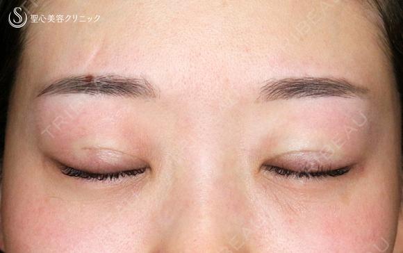 【20代女性・札幌院スタッフ】マイクロメソッド+α（術直後〜9日目） 0日後 メイン用