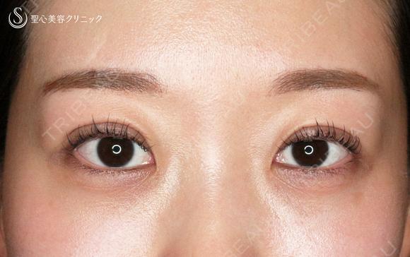 【20代女性・札幌院スタッフ】マイクロメソッド+α（術直後〜9日目） 1日後 メイン用