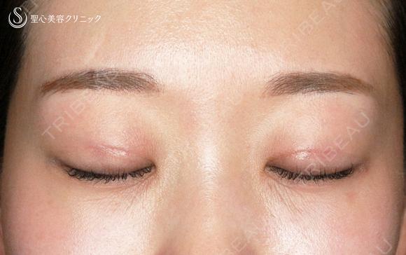 【20代女性・札幌院スタッフ】マイクロメソッド+α（術直後〜9日目） 1日後 メイン用