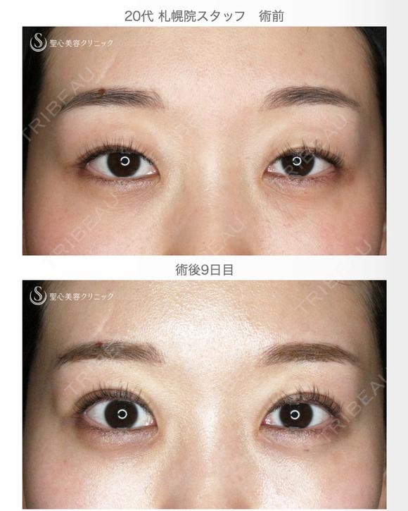 【20代女性・札幌院スタッフ】マイクロメソッド+α（術直後〜9日目） after画像 メイン用