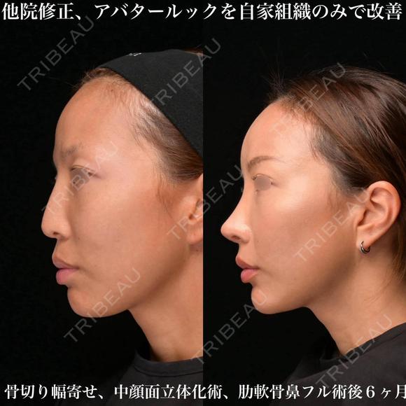 他院修正鼻整形 180日後 メイン用