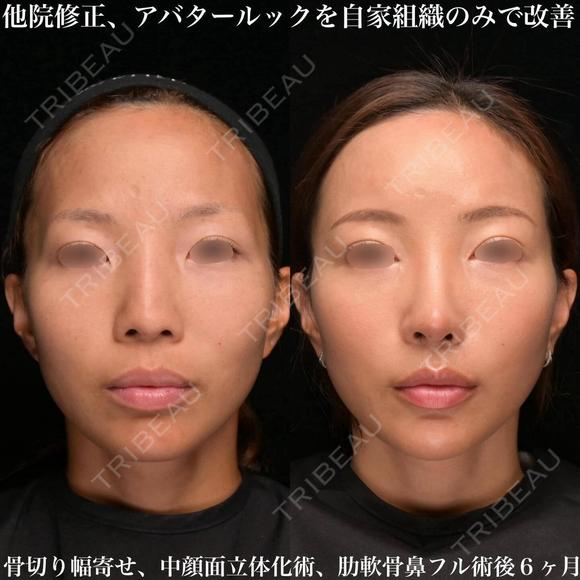 他院修正鼻整形 180日後 メイン用