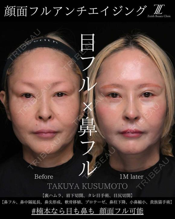 顔面フル　アンチエイジング before画像 メイン用