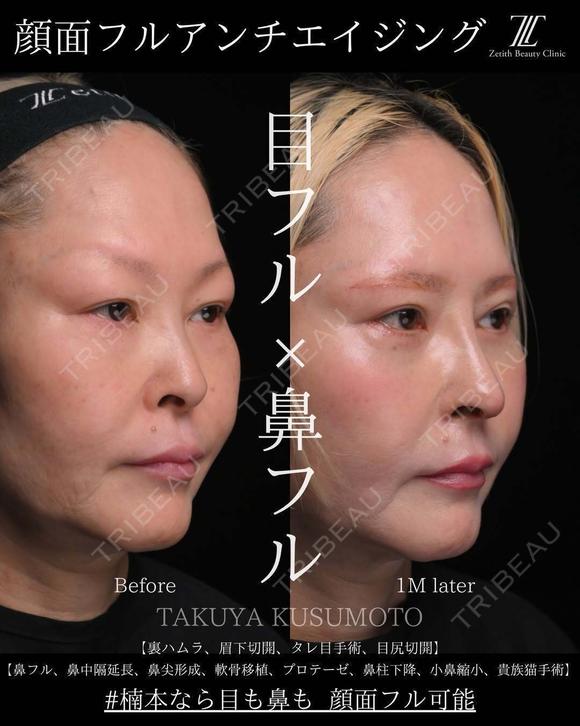 顔面フル　アンチエイジング 30日後 メイン用