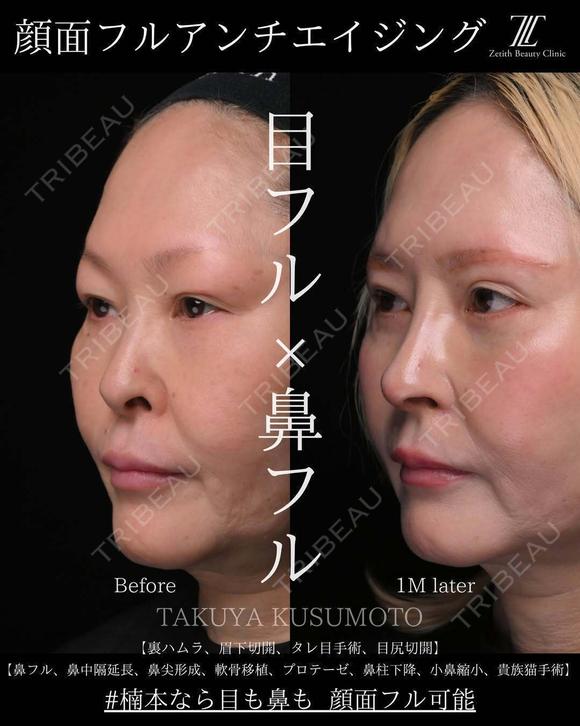 顔面フル　アンチエイジング 30日後 メイン用