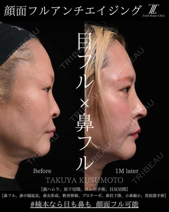 顔面フル　アンチエイジング 30日後 メイン用