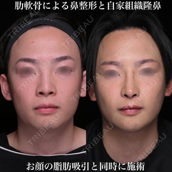 肋軟骨による鼻整形 180日後 メイン用
