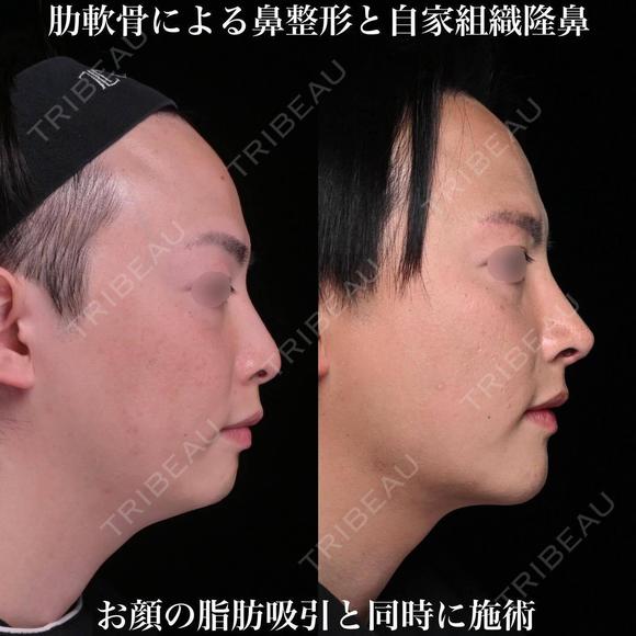 肋軟骨による鼻整形 180日後 メイン用