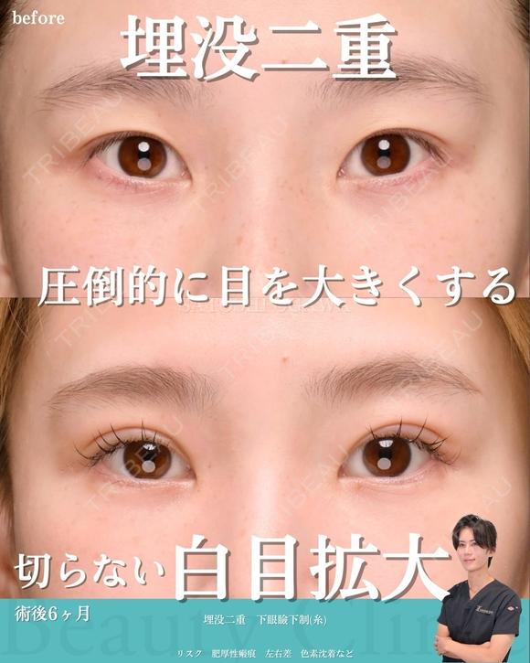 目元整形 180日後 メイン用
