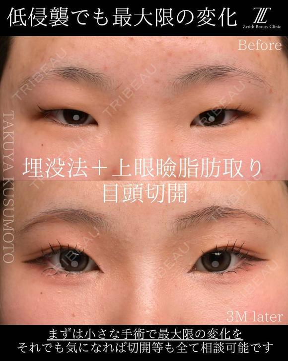 埋没法＋上眼瞼脂肪取り＋目頭切開 90日後 メイン用