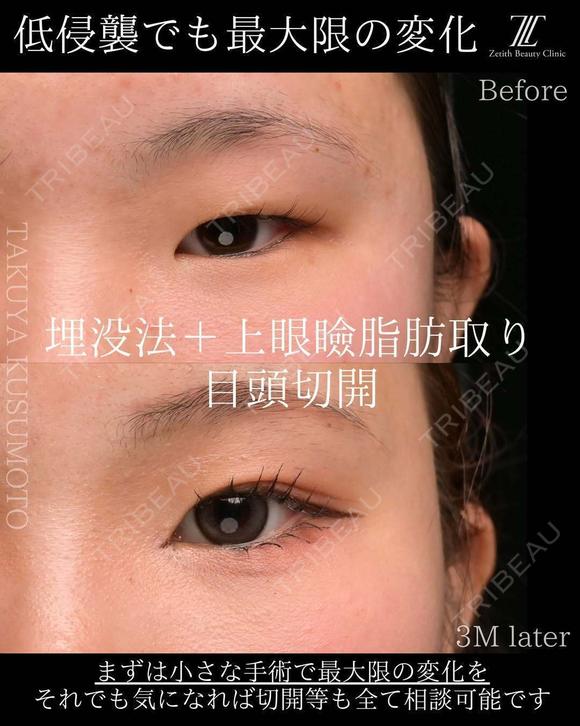 埋没法＋上眼瞼脂肪取り＋目頭切開 90日後 メイン用
