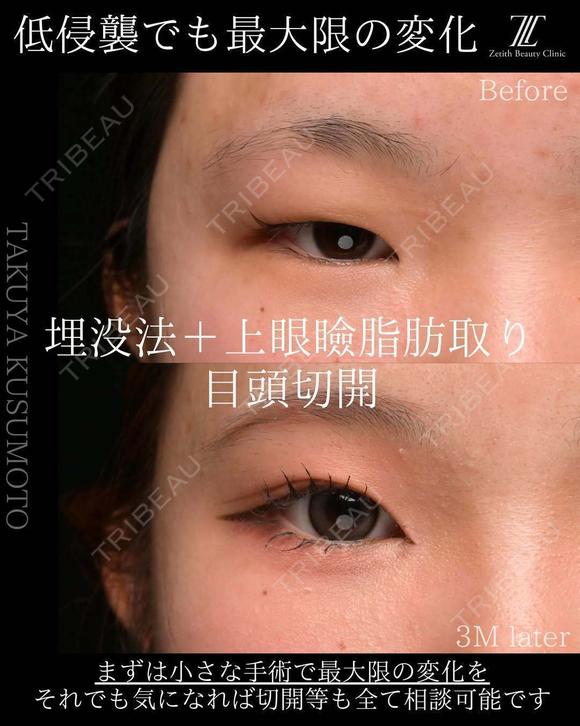 埋没法＋上眼瞼脂肪取り＋目頭切開 90日後 メイン用