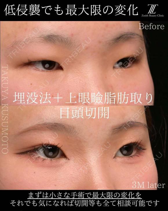 埋没法＋上眼瞼脂肪取り＋目頭切開 90日後 メイン用