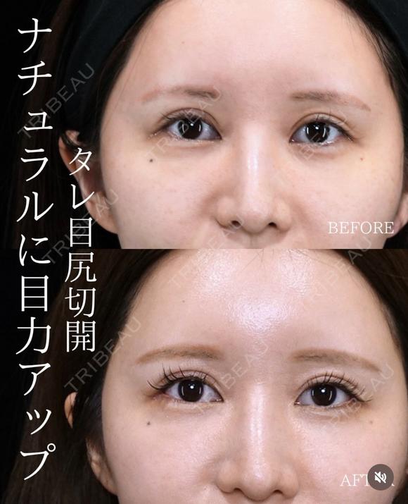 【タレ目尻切開】 before画像 メイン用