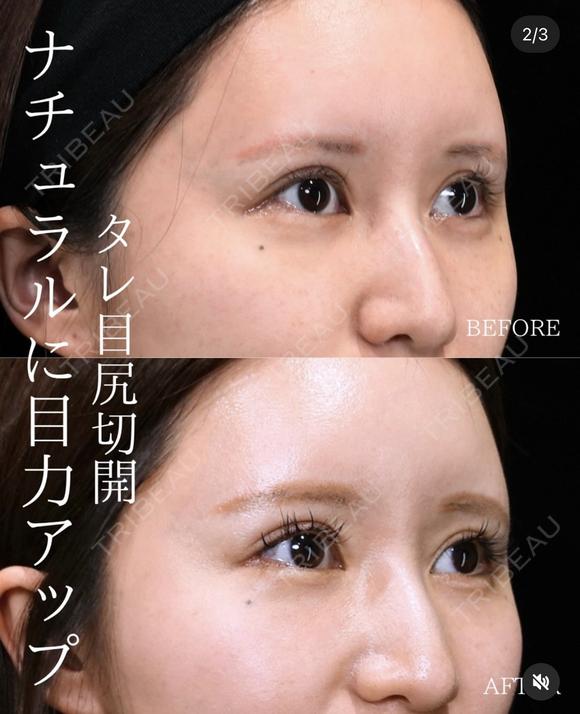 【タレ目尻切開】 30日後 メイン用