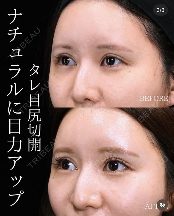【タレ目尻切開】 30日後 メイン用