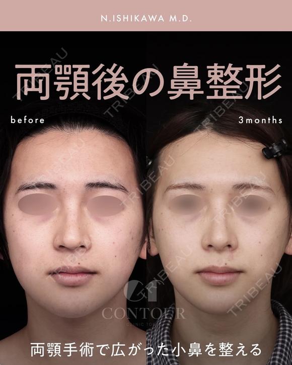 忘れ鼻整形 before画像 メイン用