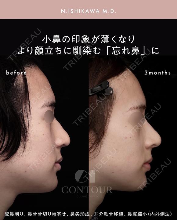 忘れ鼻整形 90日後 メイン用