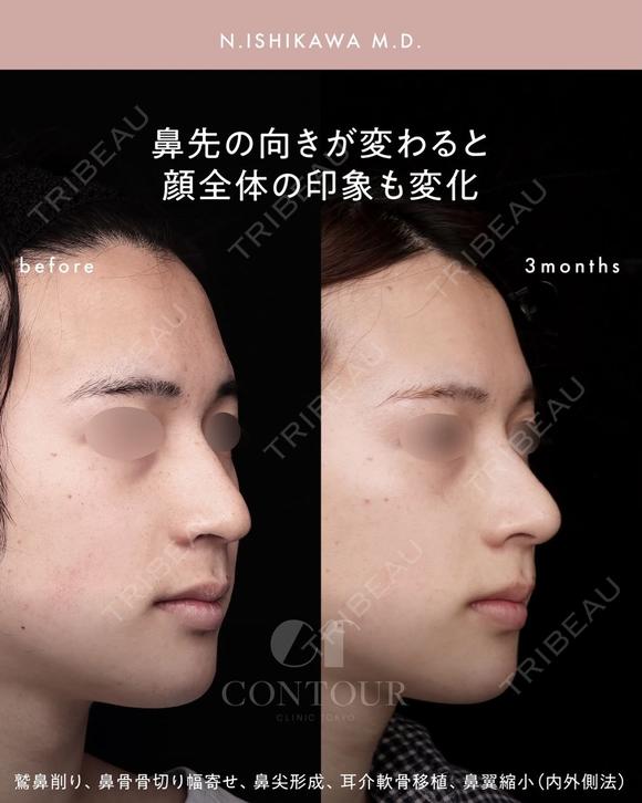 忘れ鼻整形 90日後 メイン用