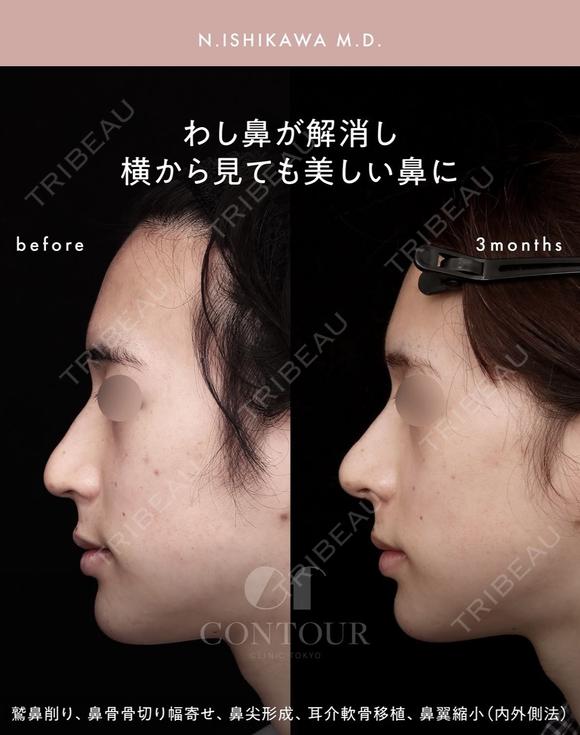 忘れ鼻整形 90日後 メイン用