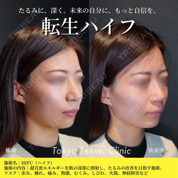 転生ハイフ before画像 メイン用
