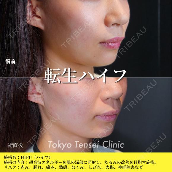 転生ハイフ 0日後 メイン用
