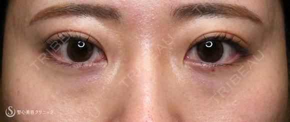 【20代女性・涙袋ヒアルで目を大きく見せる】ヒアルロン酸レスチレン・リフトリド（注入直後〜1年後） before画像 メイン用
