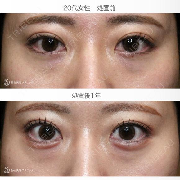 【20代女性・涙袋ヒアルで目を大きく見せる】ヒアルロン酸レスチレン・リフトリド（注入直後〜1年後） 365日後 メイン用