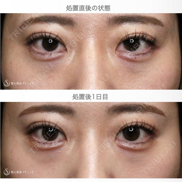 【20代女性・涙袋ヒアルで目を大きく見せる】ヒアルロン酸レスチレン・リフトリド（注入直後〜1年後） 1日後 メイン用