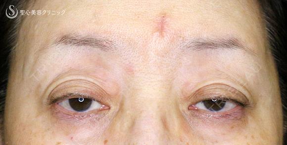【60代女性・ハードコンタクトによる眼瞼下垂】切らない眼瞼下垂+α法（術直後〜2年後） before画像 メイン用