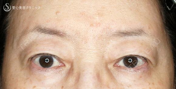 【60代女性・ハードコンタクトによる眼瞼下垂】切らない眼瞼下垂+α法（術直後〜2年後） 730日後 メイン用
